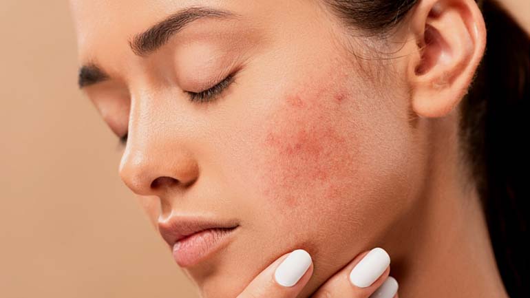 Skin Infections are quite common in Raja Ampat